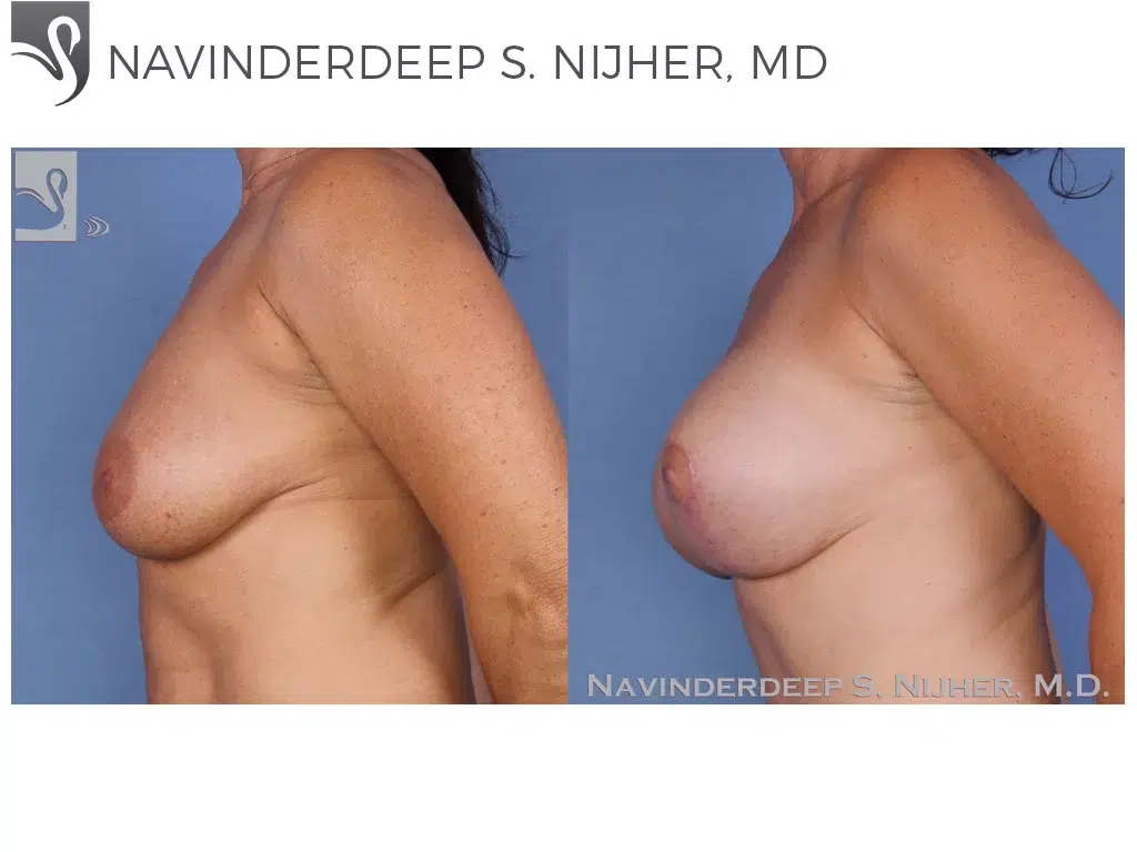 Before and After Image: Breast Revisions Case #20729 - left-side