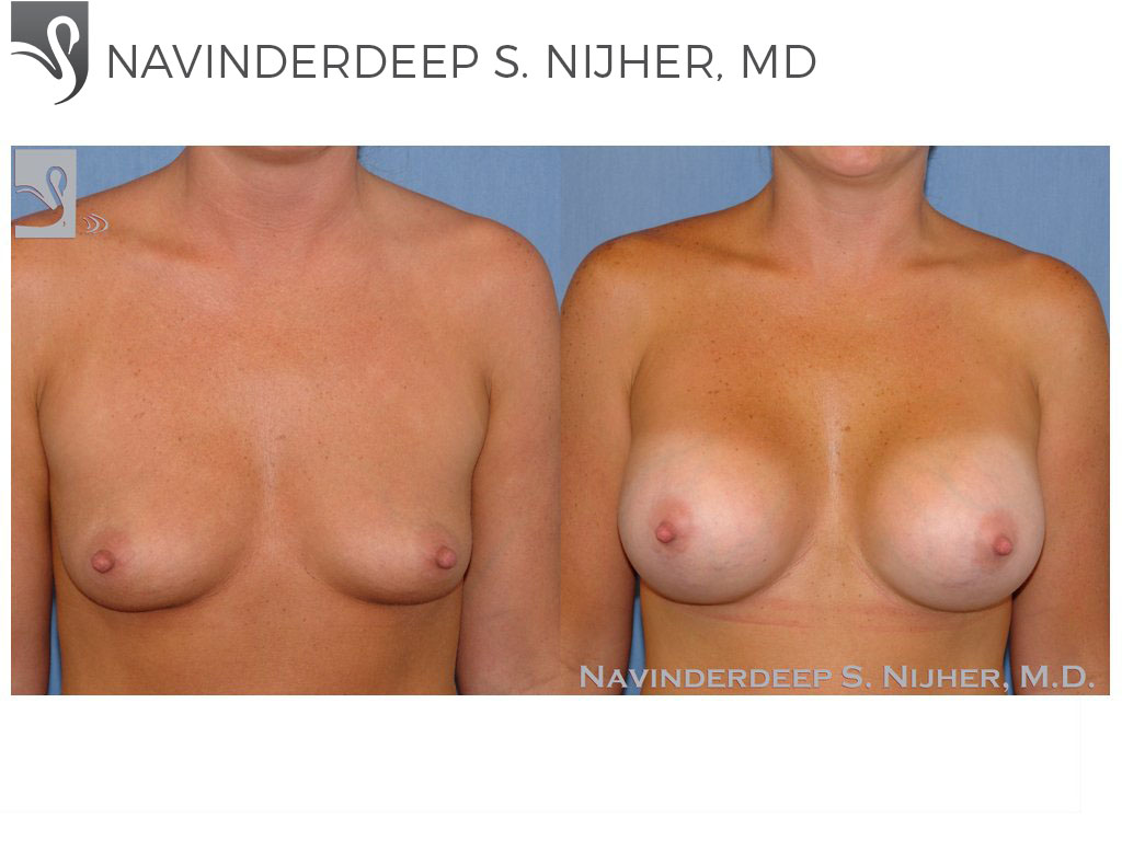 Before and After Image: Breast Augmentation Case #21221 - front