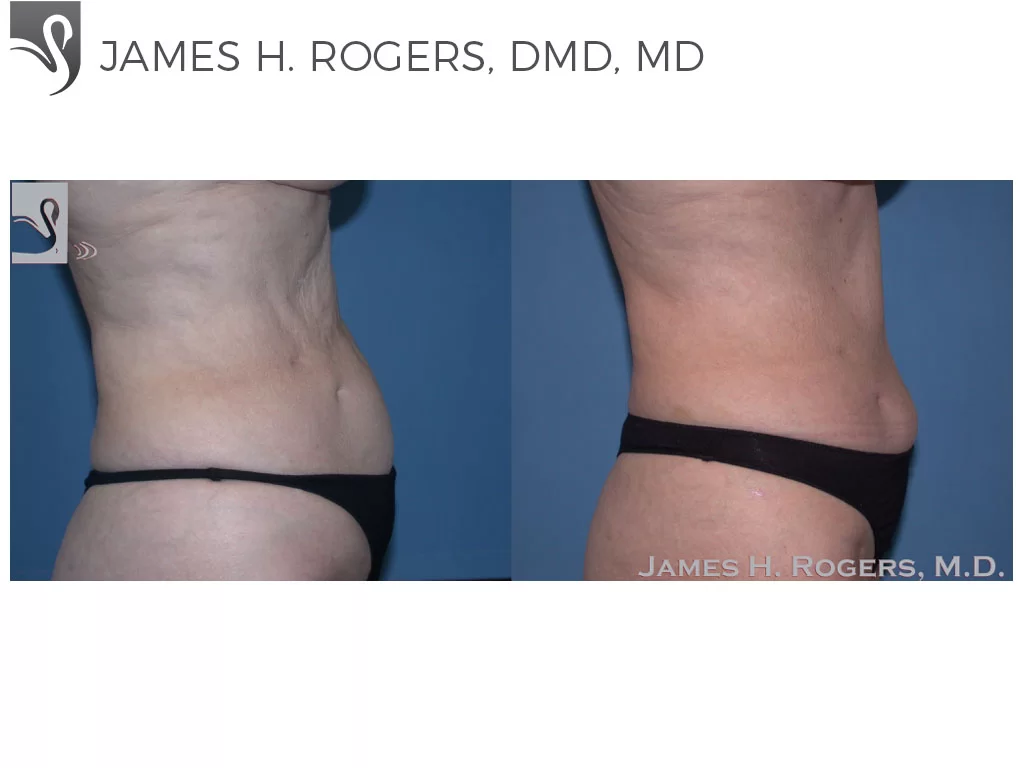 Before and After Image: Abdominoplasty (Tummy Tuck) Case #22904 - right-side