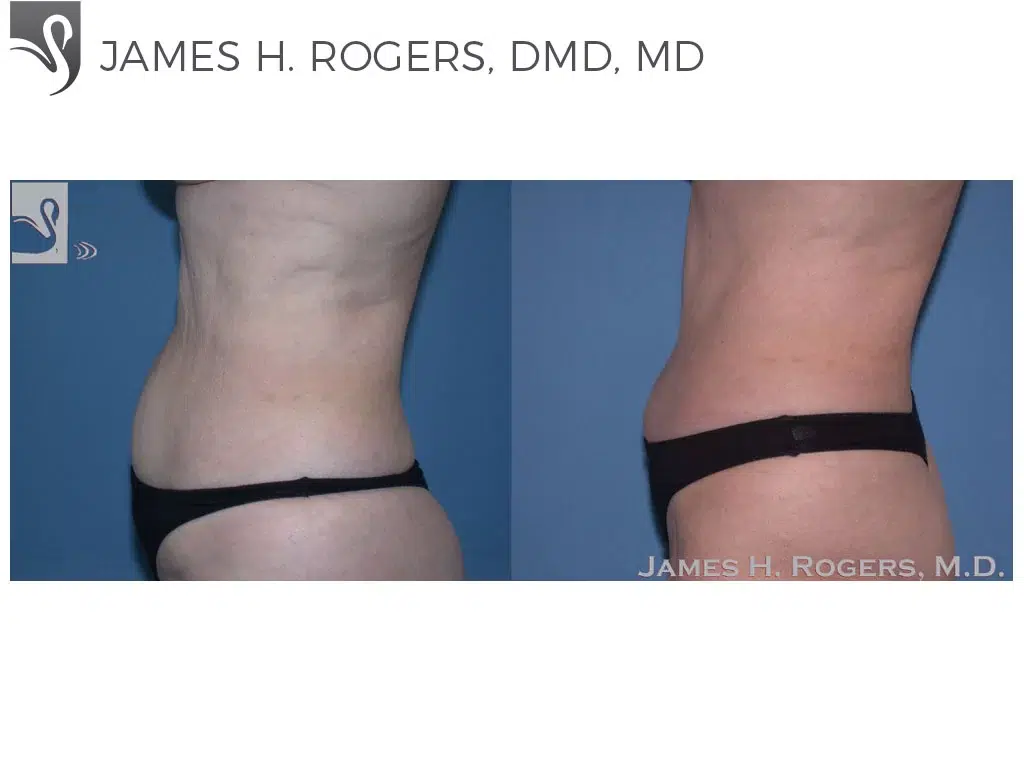 Before and After Image: Abdominoplasty (Tummy Tuck) Case #22904 - left-side