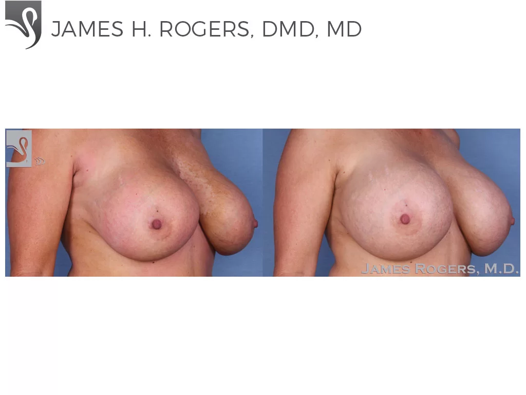 Before and After Image: Breast Revisions Case #23065 - right-front-oblique