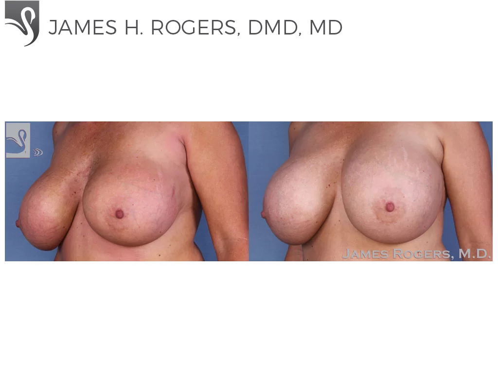Before and After Image: Breast Revisions Case #23065 - left-front-oblique
