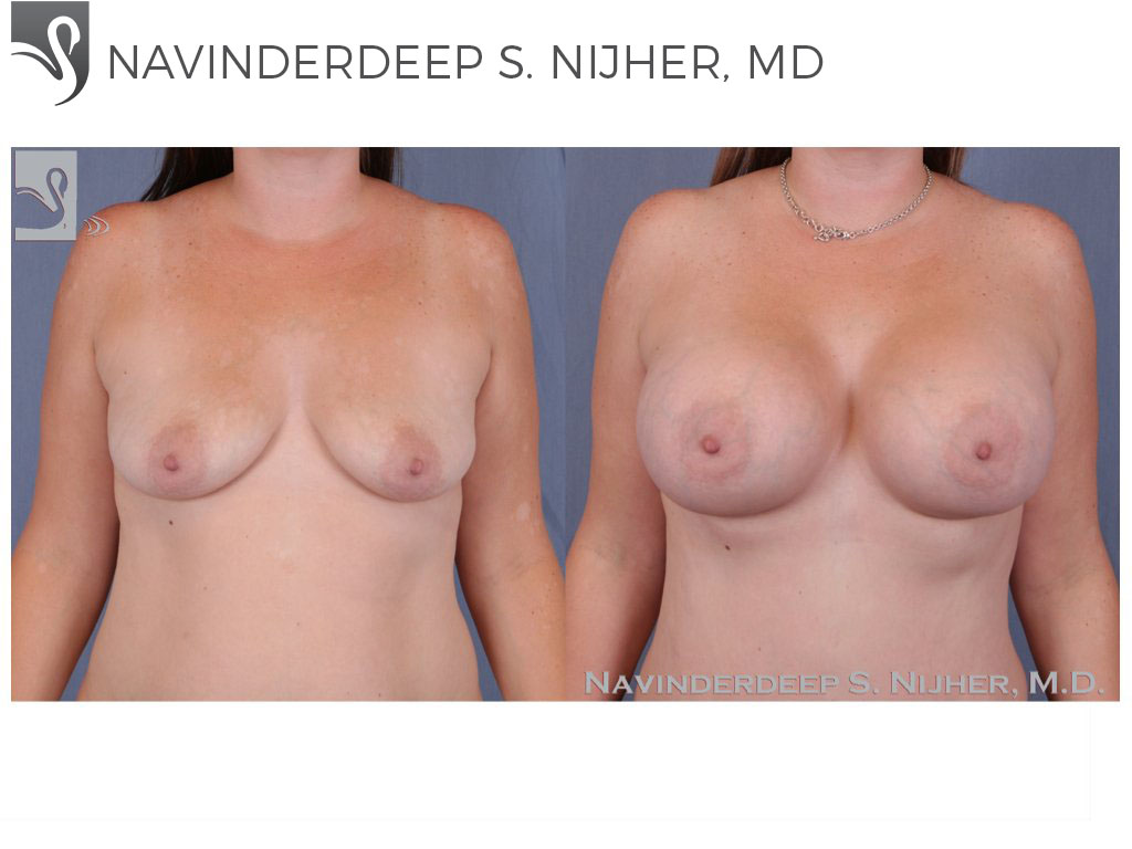 Before and After Image: Breast Augmentation Case #23428 - front