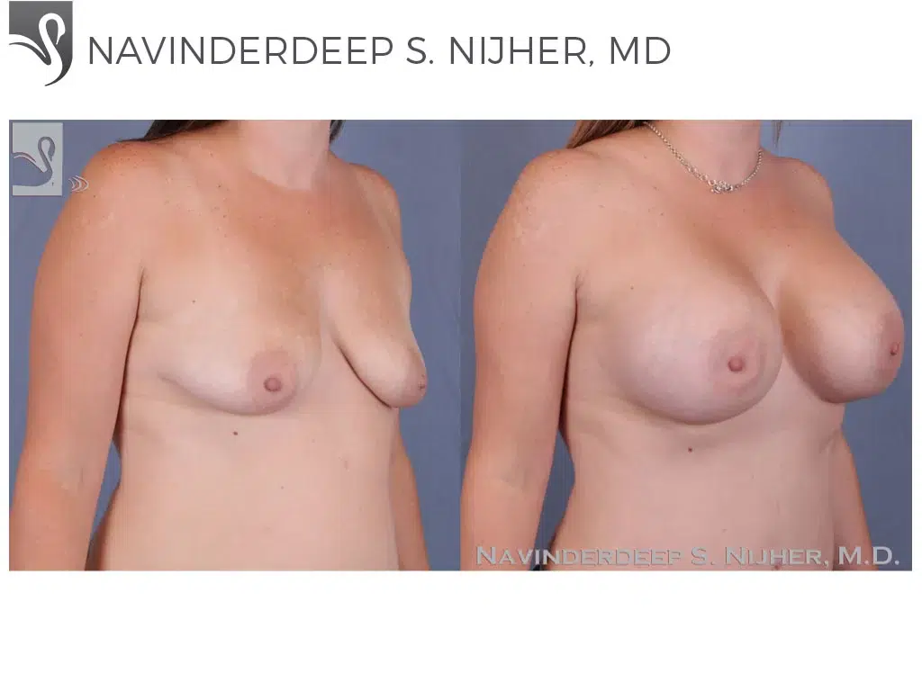 Before and After Image: Breast Augmentation Case #23428 - right-front-oblique