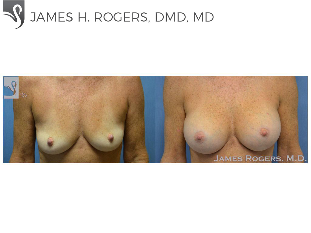 Before and After Image: Breast Augmentation Case #23716 - front
