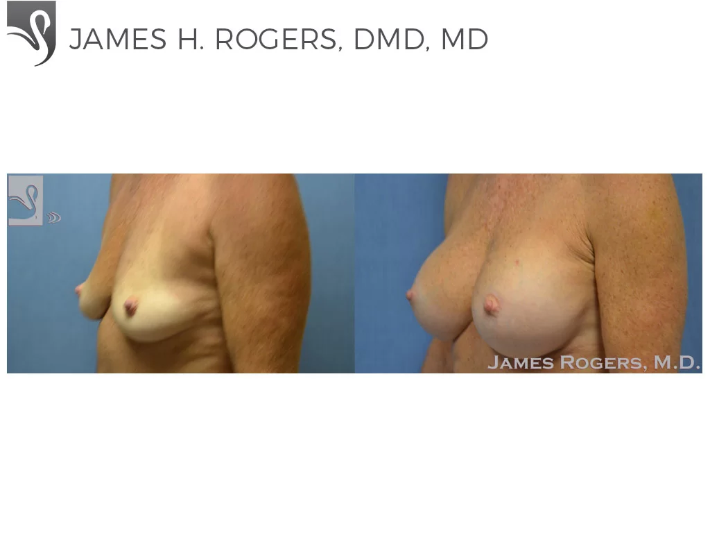 Before and After Image: Breast Augmentation Case #23716 - left-front-oblique
