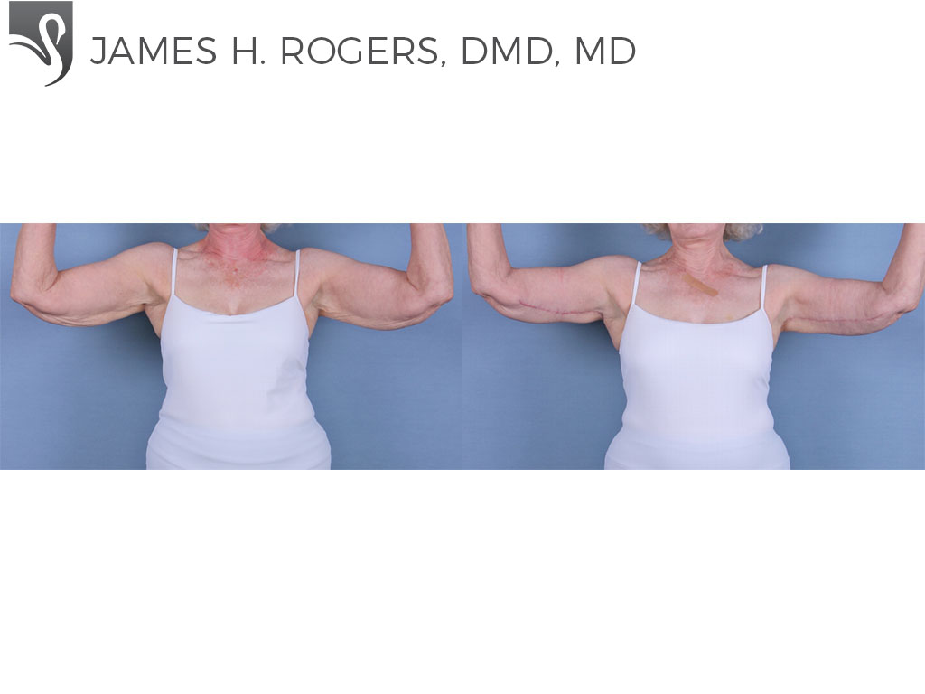 Before and After Image: Arm Lift Case #24257