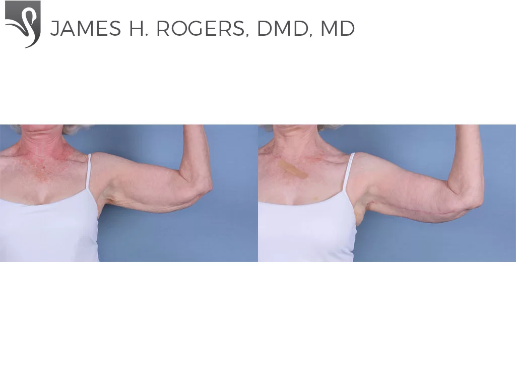 Before and After Image: Arm Lift Case #24257 - front