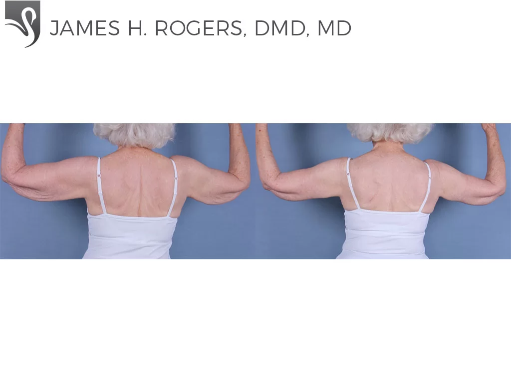 Before and After Image: Arm Lift Case #24257 - back