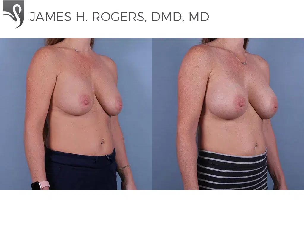 Before and After Image: Breast Augmentation Case #24625 - right-front-oblique