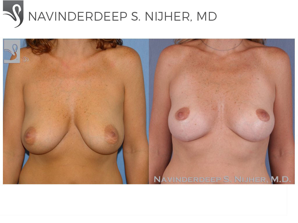Before and After Image: Breast Lift (Mastopexy) Case #51344 - front