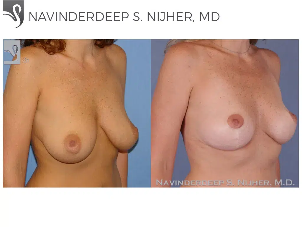 Before and After Image: Breast Lift (Mastopexy) Case #51344 - right-front-oblique