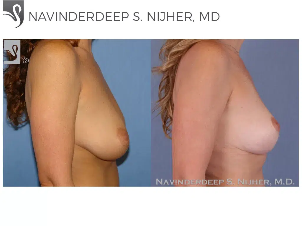 Before and After Image: Breast Lift (Mastopexy) Case #51344 - right-side