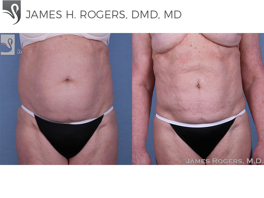 Before and After Image: Liposuction Case #24966