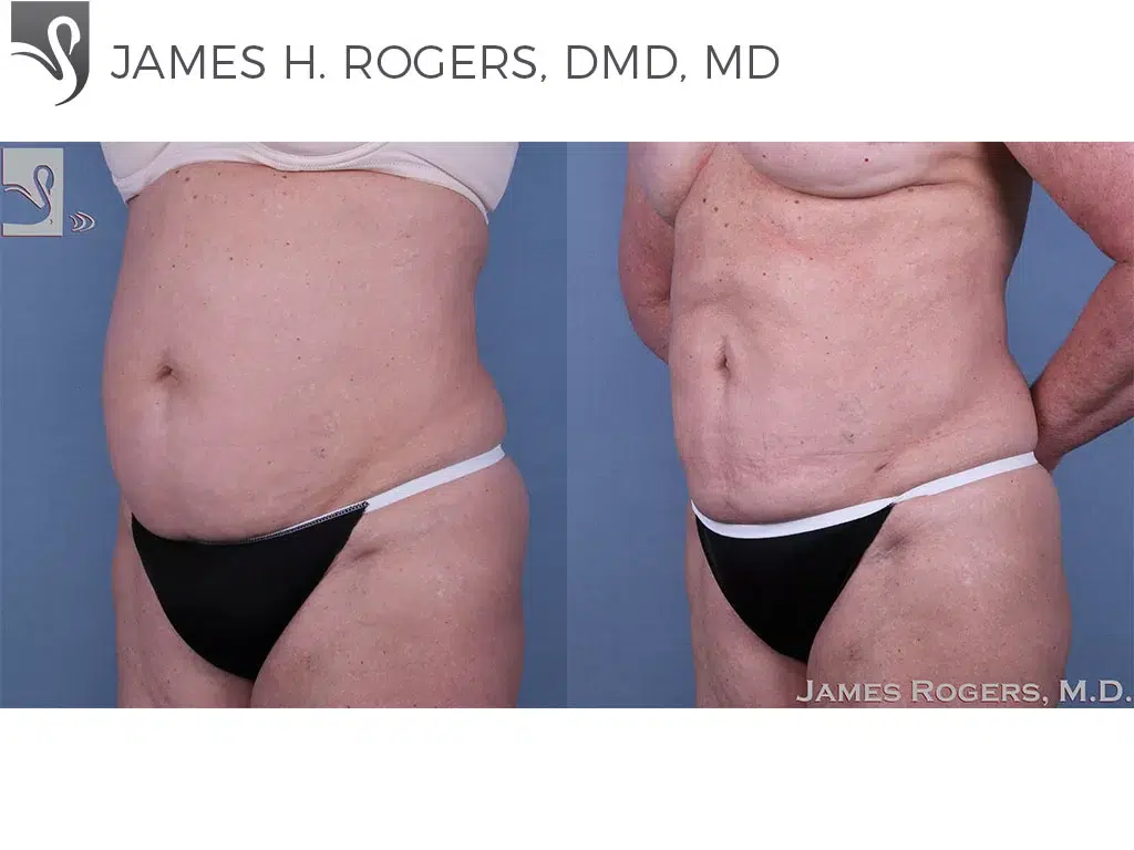 Before and After Image: Liposuction Case #24966 - left-front-oblique
