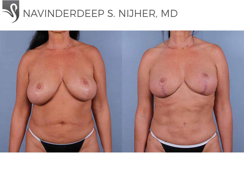 Before and After Image: Female Breast Reduction Case #25089