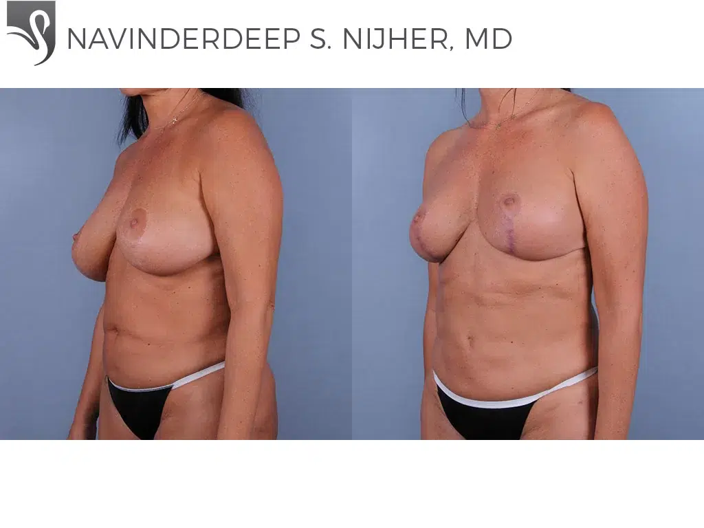 Before and After Image: Female Breast Reduction Case #25089 - left-front-oblique