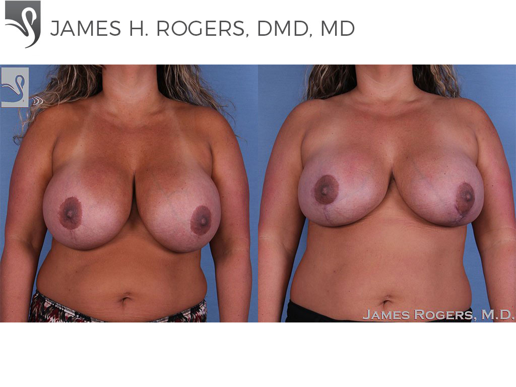 Before and After Image: Breast Revisions Case #27846 - front
