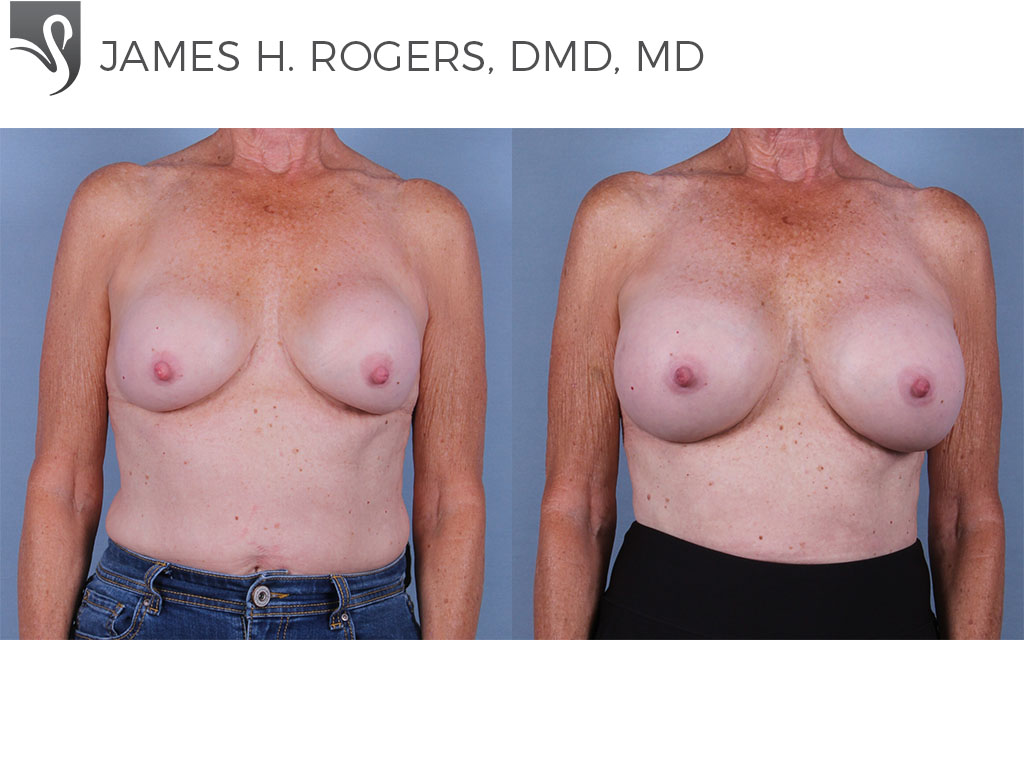 Before and After Image: Breast Revisions Case #27898