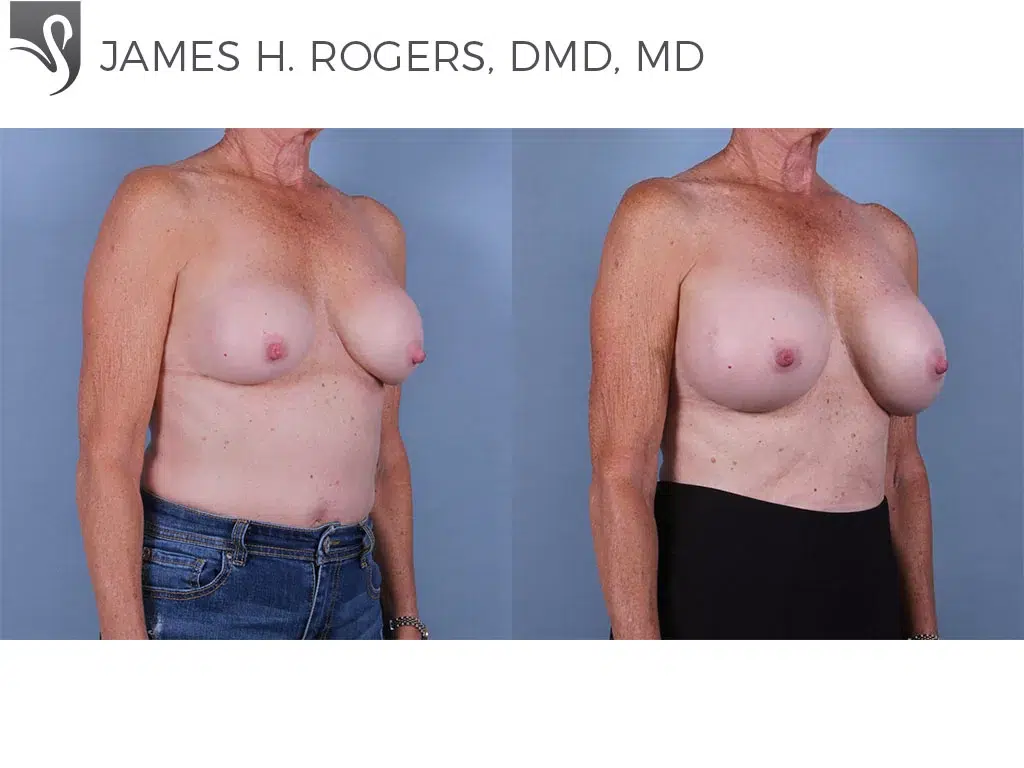 Before and After Image: Breast Revisions Case #27898 - right-front-oblique
