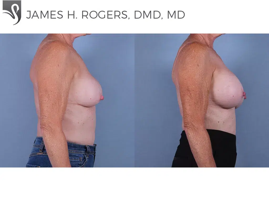 Before and After Image: Breast Revisions Case #27898 - right-side