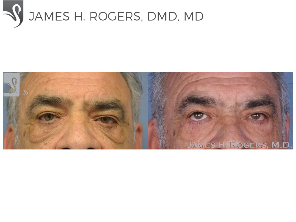 Before and After Image: Eyelid Surgery Case #28067 - front