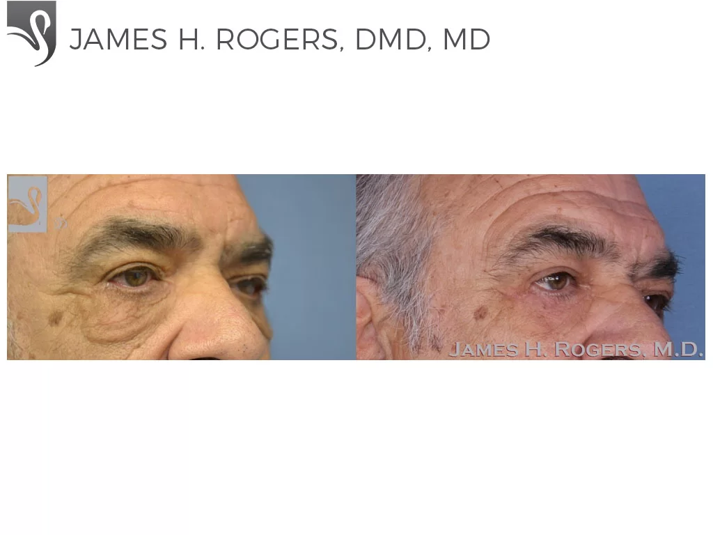 Before and After Image: Eyelid Surgery Case #28067 - right-front-oblique