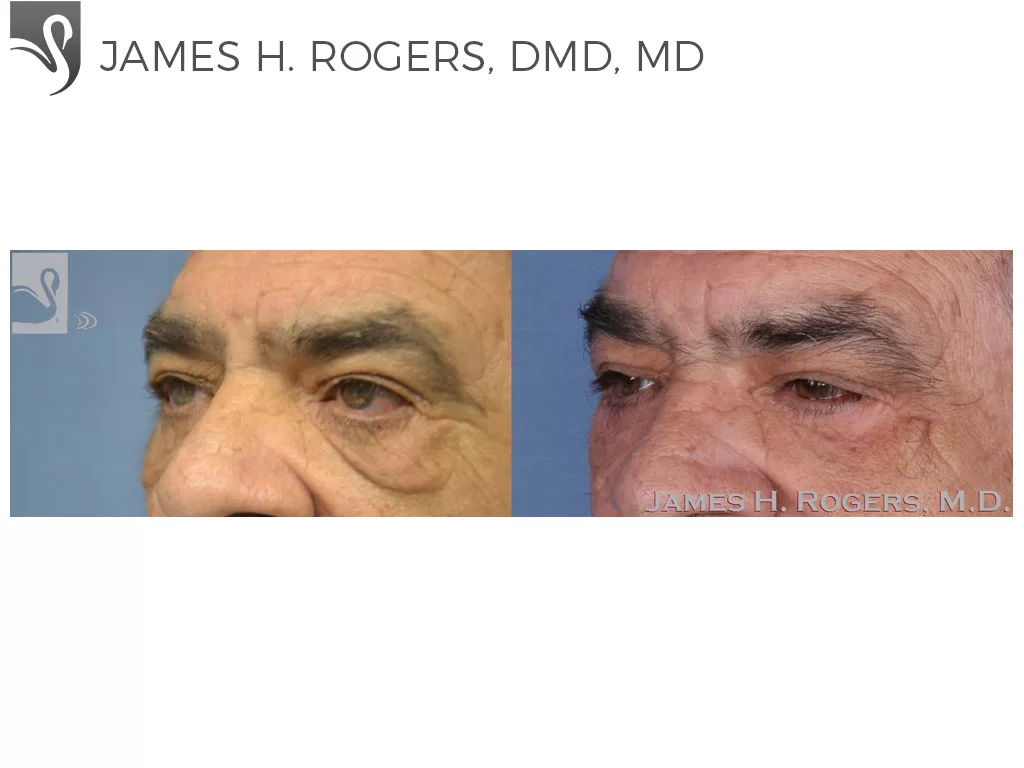 Before and After Image: Eyelid Surgery Case #28067 - left-front-oblique