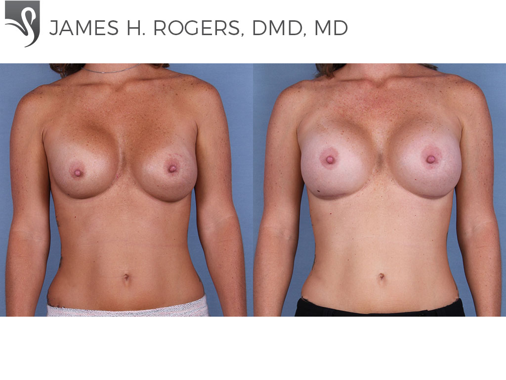 Before and After Image: Breast Revisions Case #28791 - front