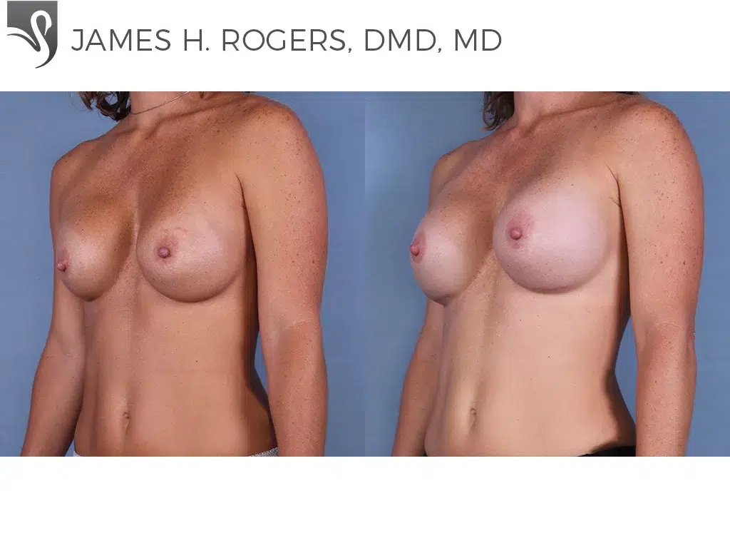 Before and After Image: Breast Revisions Case #28791 - left-front-oblique