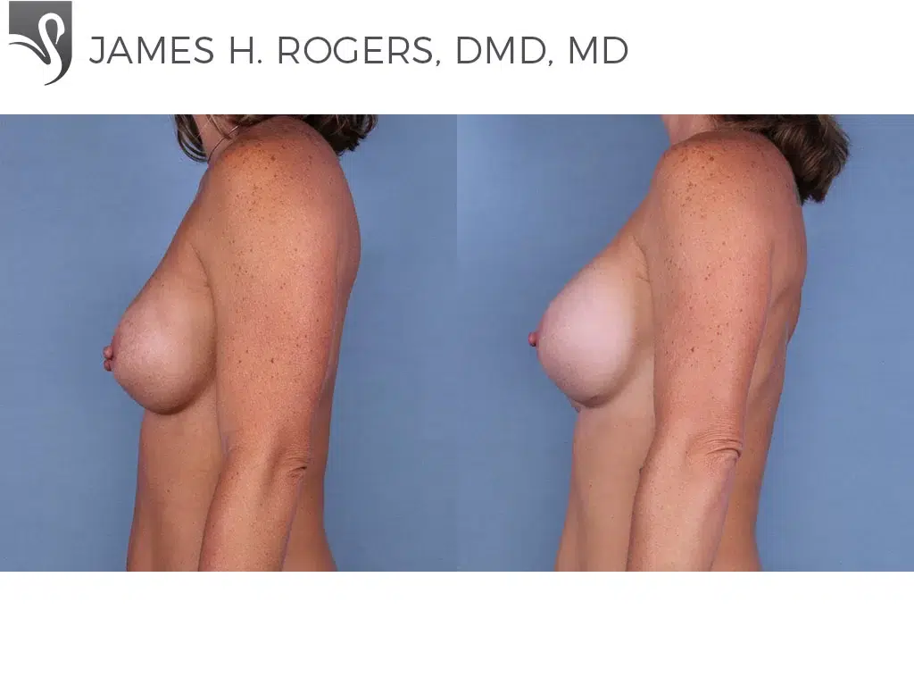 Before and After Image: Breast Revisions Case #28791 - left-side