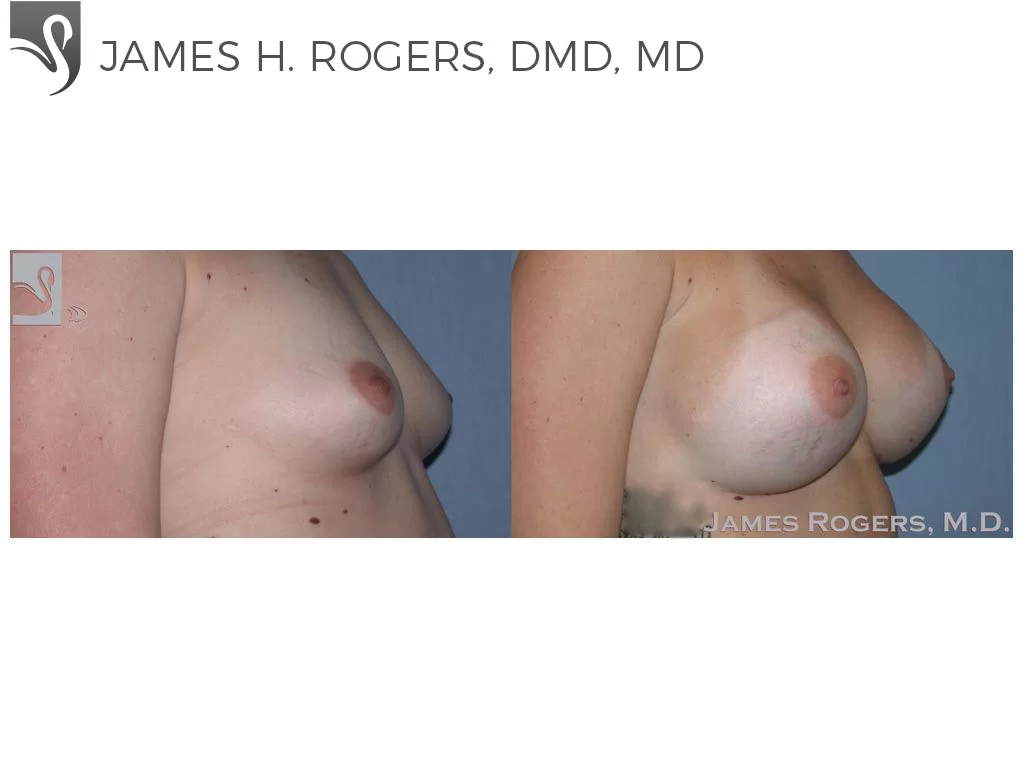 Before and After Image: Breast Augmentation Case #29092 - right-front-oblique