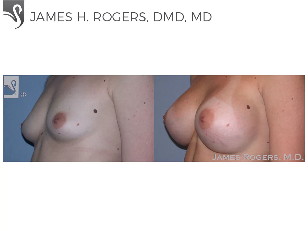 Before and After Image: Breast Augmentation Case #29092 - left-front-oblique