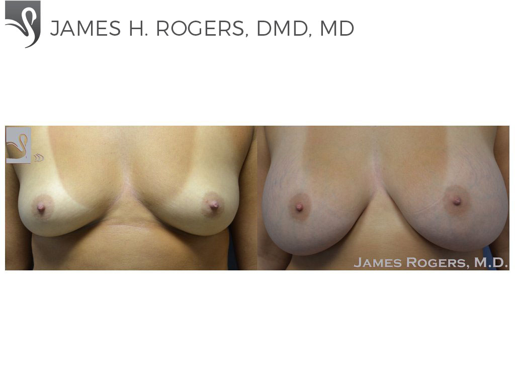 Before and After Image: Breast Augmentation Case #29756 - front