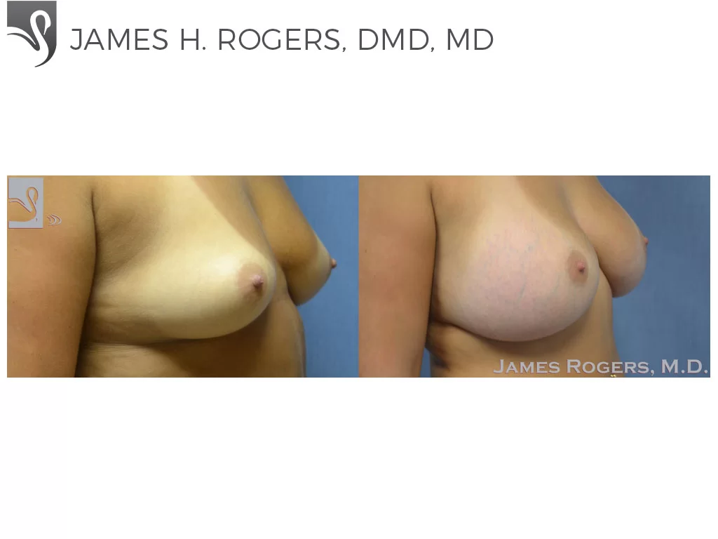 Before and After Image: Breast Augmentation Case #29756 - right-front-oblique