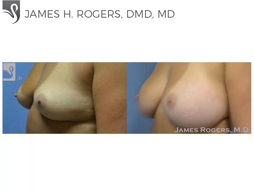 Before and After Image: Breast Augmentation Case #29756 - left-front-oblique