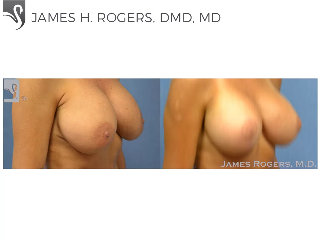 Before and After Image: Breast Revisions Case #30036 - right-front-oblique