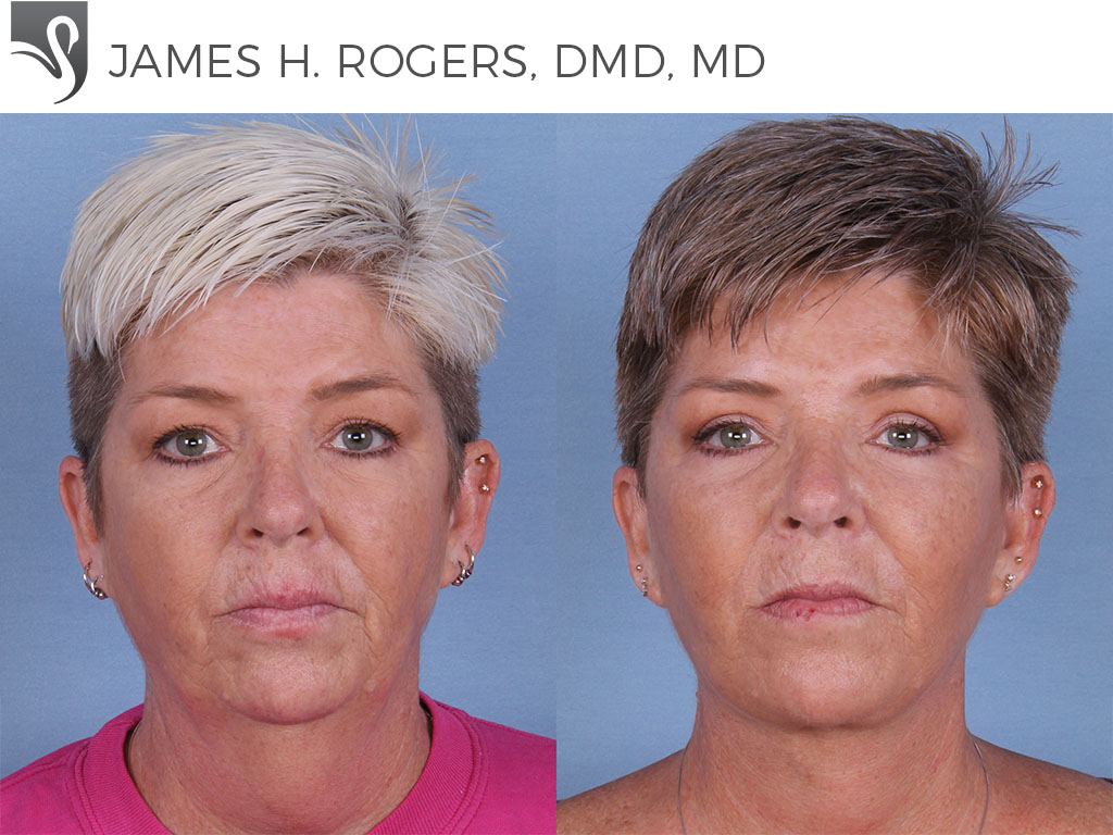 Before and After Image: Face Lift Case #30273 - front