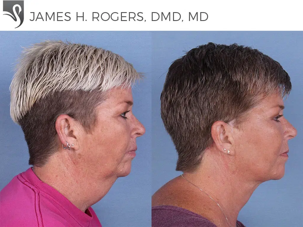 Before and After Image: Face Lift Case #30273 - right-side