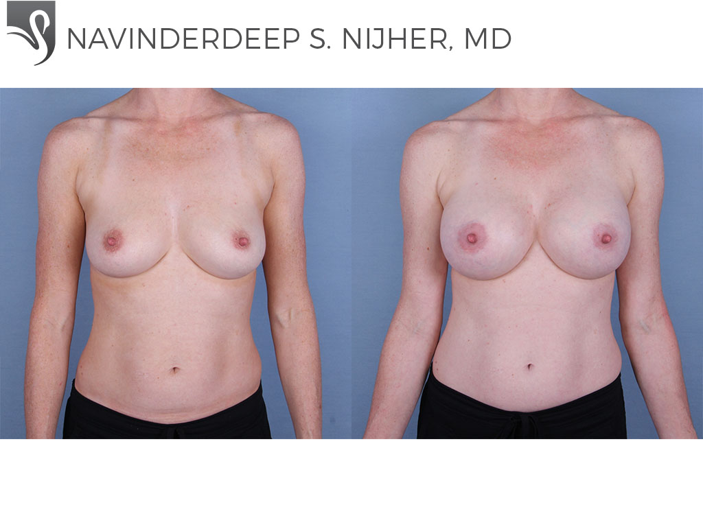 Before and After Image: Breast Augmentation Case #31047 - front