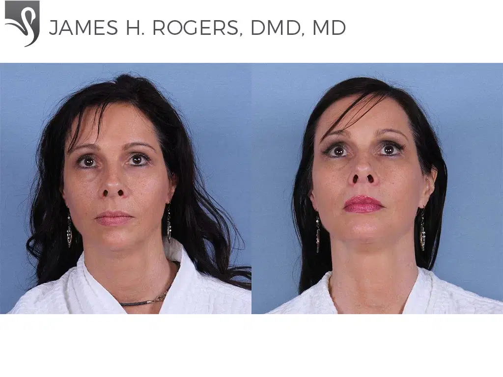 Before and After Image: Facial Implants Case #31068