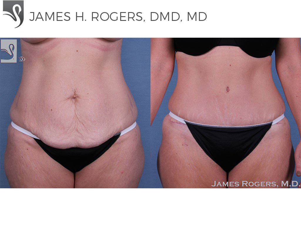 Before and After Image: Abdominoplasty (Tummy Tuck) Case #32605 - front