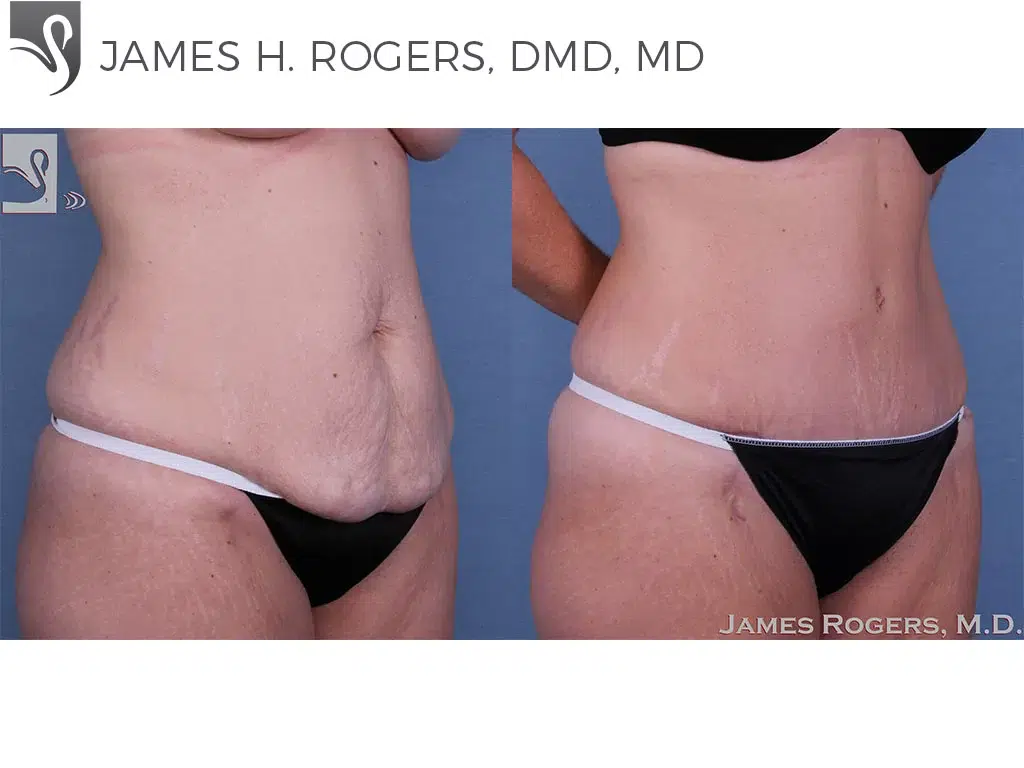 Before and After Image: Abdominoplasty (Tummy Tuck) Case #32605 - right-front-oblique
