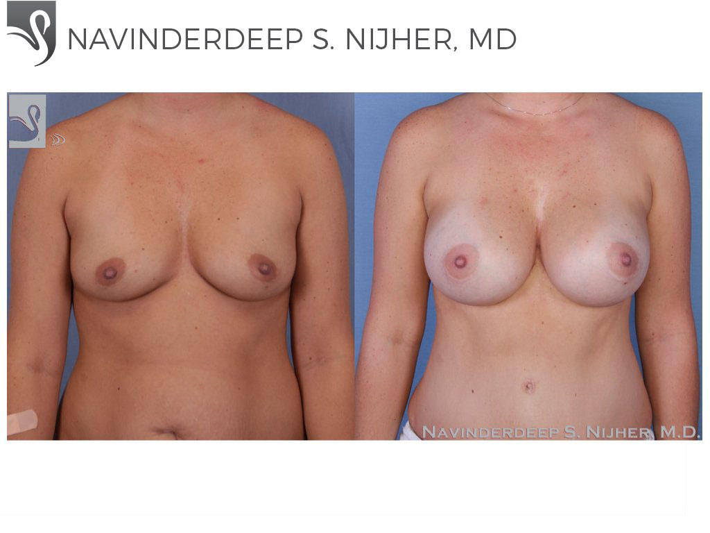 Before and After Image: Breast Augmentation Case #33055 - front