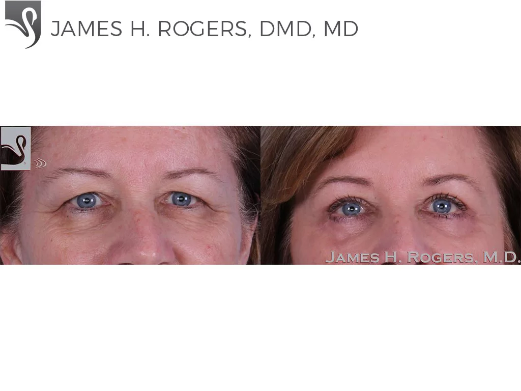 Before and After Image: Eyelid Surgery Case #33375 - front