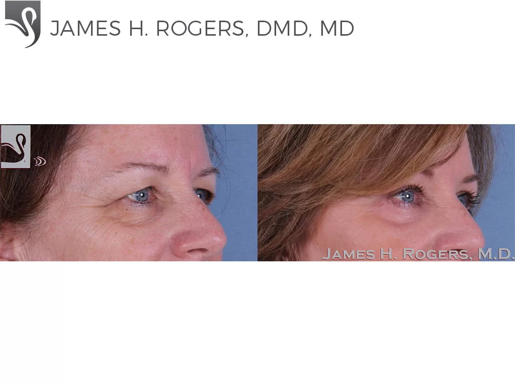 Before and After Image: Eyelid Surgery Case #33375 - right-front-oblique