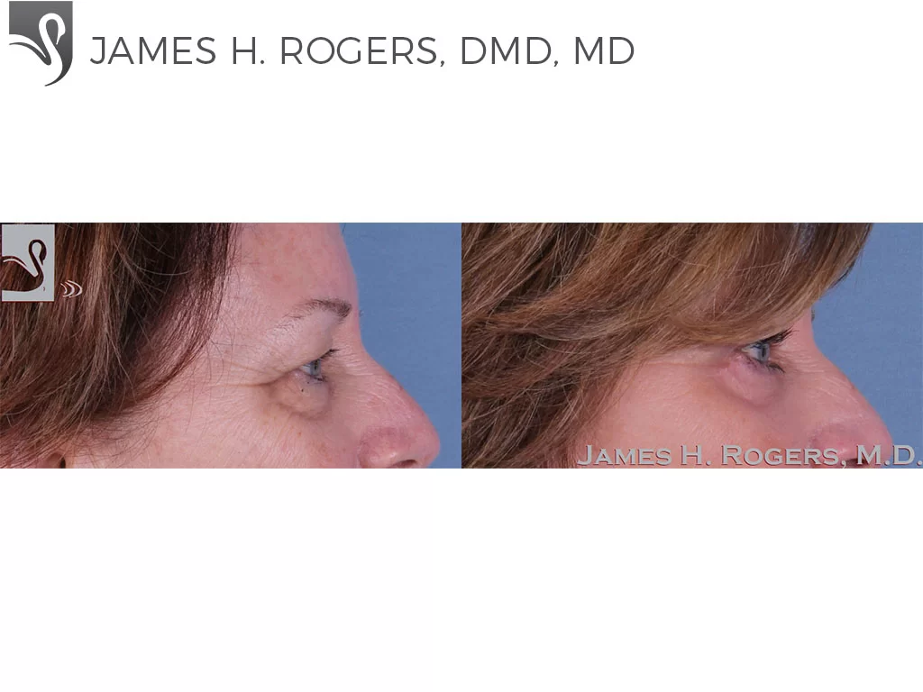 Before and After Image: Eyelid Surgery Case #33375 - right-side