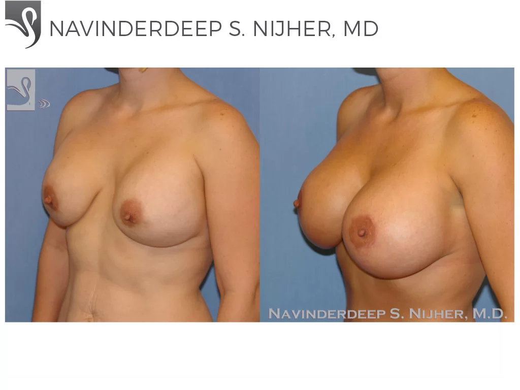 Before and After Image: Breast Revisions Case #34573 - left-front-oblique