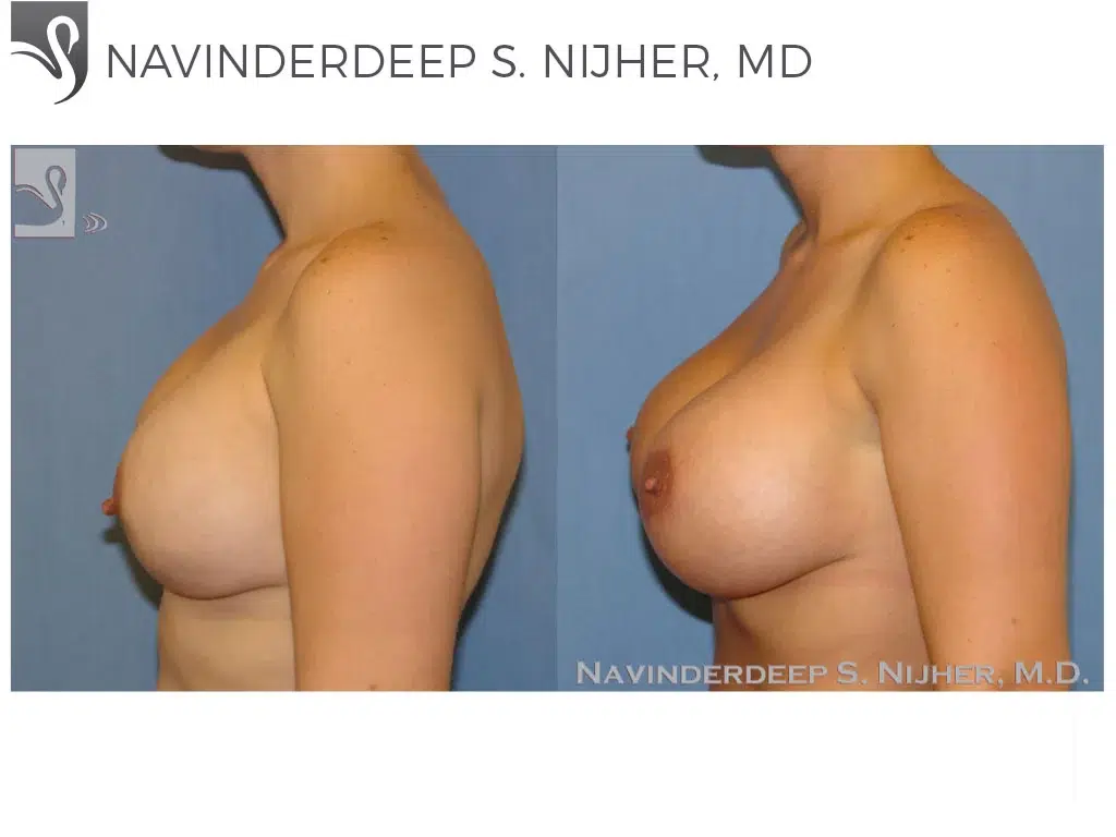Before and After Image: Breast Revisions Case #34573 - left-side
