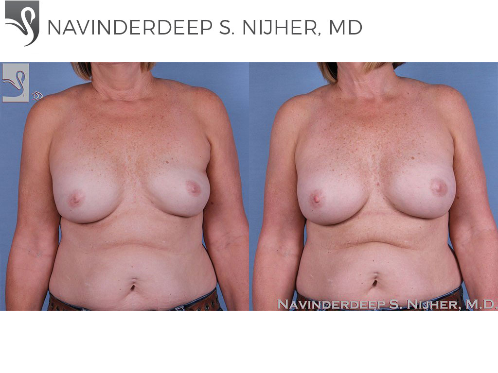 Before and After Image: Breast Revisions Case #63645 - front